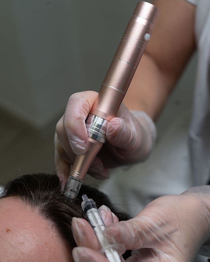 PRP for Hair Restoration