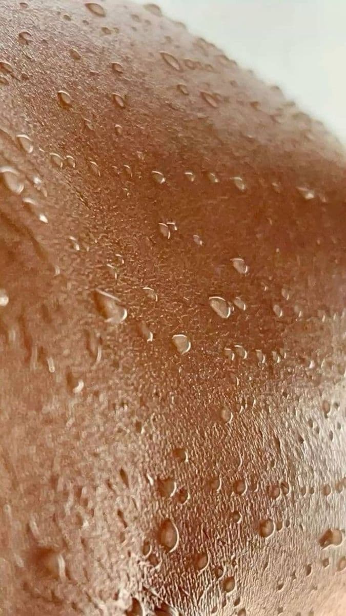 Hyperhidrosis (Excessive Sweating)